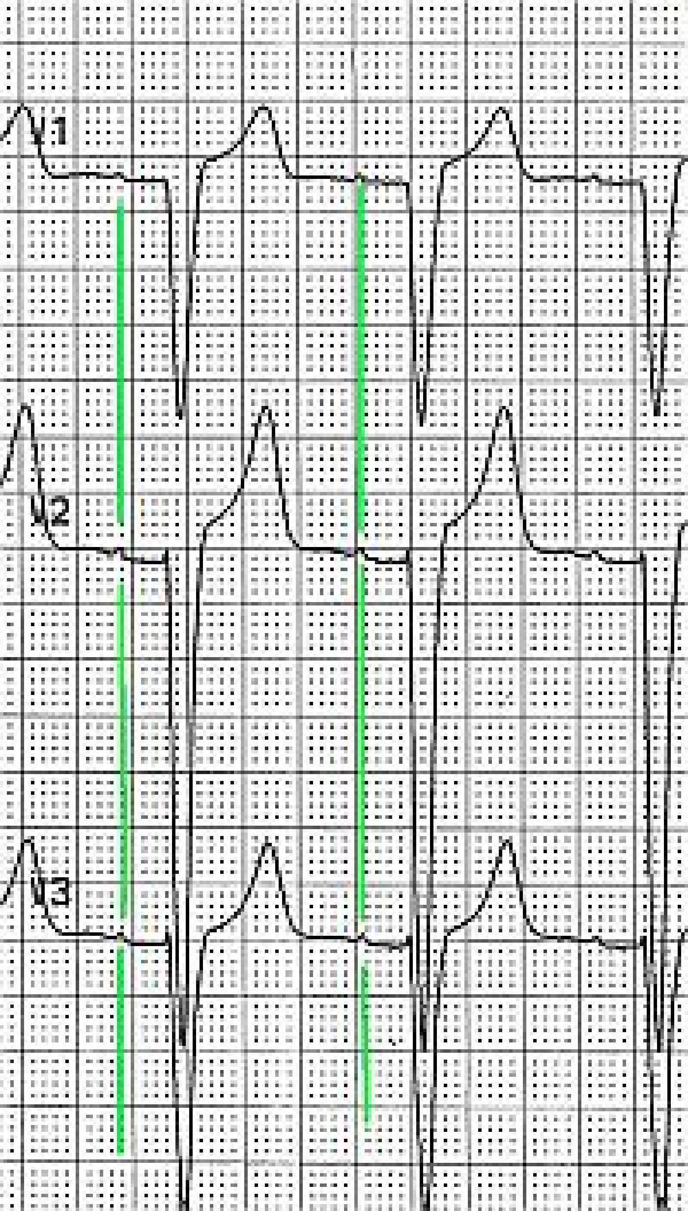 left-bundle-branch-block-ecg-guru-instructor-resources